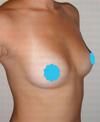 Breast Augmentation Breast Augmentation - Before