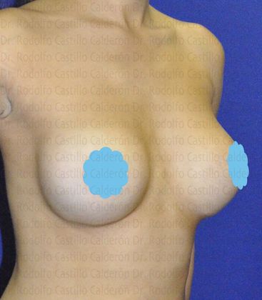 Breast Augmentation Breast Augmentation - After