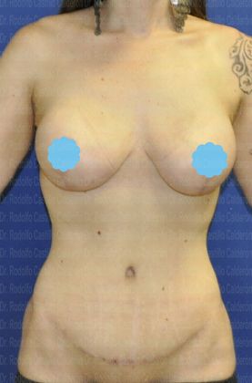 Post Bariatric Plastic Surgery: Patient With Belt Lipectomy and Breast Lift - After her Body Lift - Belt Lipectomy and Breast Lift