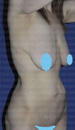 Post Bariatric Plastic Surgery: Patient With Belt Lipectomy and Breast Lift - Before her Body Lift - Belt Lipectomy and Breast Lift