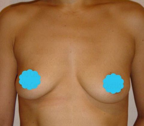 Breast Augmentation: Breast Augmentation - Before Breast augmentation Frontal view