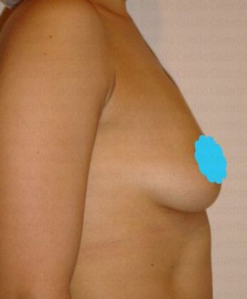 Breast Augmentation: Breast Augmentation - Before Breast augmentation lateral view