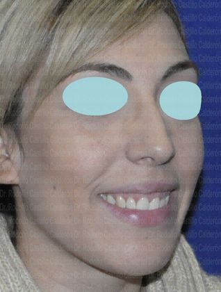 Rhinoplasty: Rhinoplasty and inferior Blepharoplasty - Before Rhinoplasty oblique View