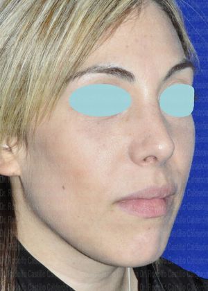 Rhinoplasty: Rhinoplasty and inferior Blepharoplasty - After Rhinoplasty Oblique View