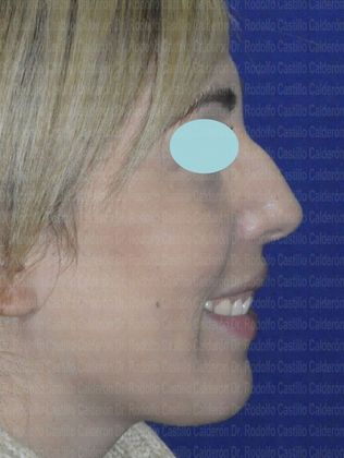 Rhinoplasty: Rhinoplasty and inferior Blepharoplasty - Before Rhinoplasty Lateral View