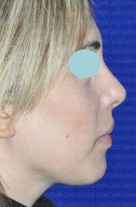 Rhinoplasty: Rhinoplasty and inferior Blepharoplasty - After Rhinoplasty Lateral View
