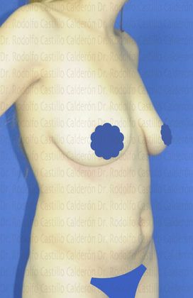 Mommy Makeover -Abdomen, Breast, Lipo, BBL-: Mommy Makeover - Before Mommy Makeover oblique View