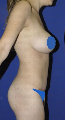 Mommy Makeover -Abdomen, Breast, Lipo, BBL- Mommy Makeover - After