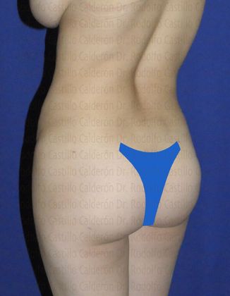 Mommy Makeover -Abdomen, Breast, Lipo, BBL-: Mommy Makeover - After Mommy Makeover oblique-posterior View