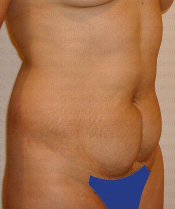 Tummy Tuck Tummy Tuck - Before