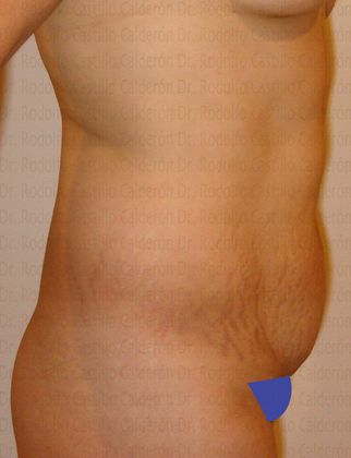 Tummy Tuck: Tummy Tuck - Before Abdominoplasty lateral view