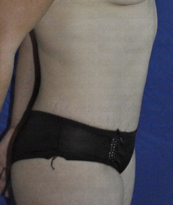 Tummy Tuck: Tummy Tuck - Before Abdominoplasty lateral view