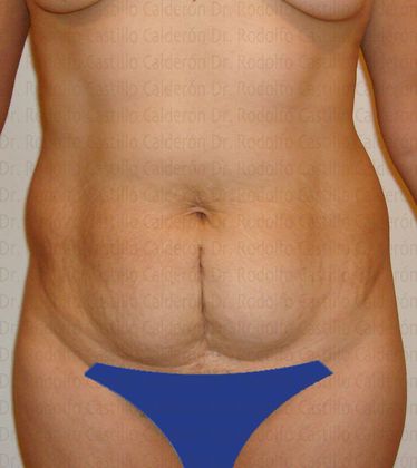 Tummy Tuck: Tummy Tuck - Before Abdominoplasty frontal view