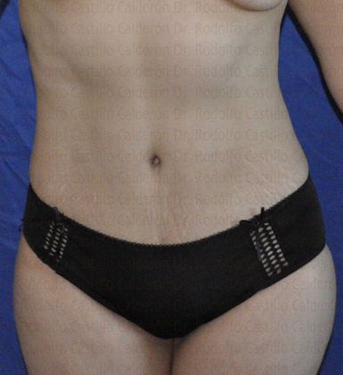 Tummy Tuck: Tummy Tuck - After Abdominoplasty frontal view
