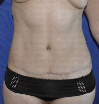 Tummy Tuck: Tummy Tuck - Before Abdominoplasty frontal view showing scar