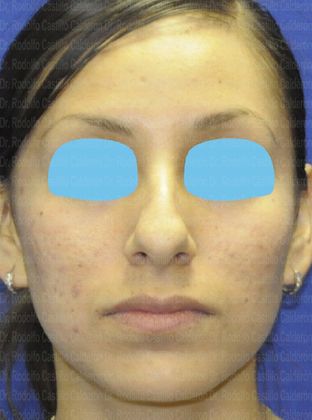 Rhinoplasty: Open Rhinoplasty - Before Rhinoplasty frontal view