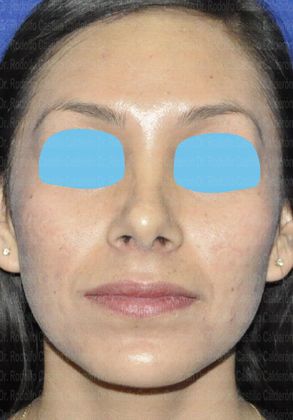 Rhinoplasty: Open Rhinoplasty - After Rhinoplasty frontal view