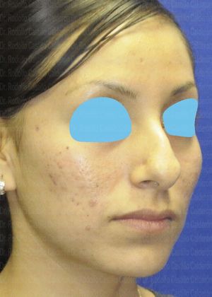 Rhinoplasty: Open Rhinoplasty - Before Rhinoplasty oblique view