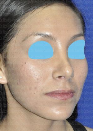 Rhinoplasty: Open Rhinoplasty - After Rhinoplasty oblique view