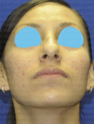 Rhinoplasty: Open Rhinoplasty - Before Rhinoplasty inferior view