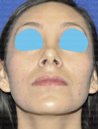 Rhinoplasty: Open Rhinoplasty - After Rhinoplasty inferior view