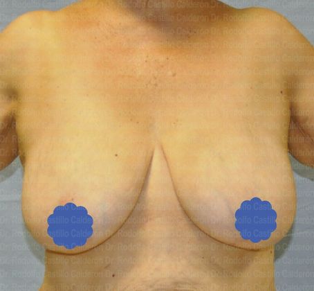 Breast Lift Patient with Breast Lift Without Implants - Before