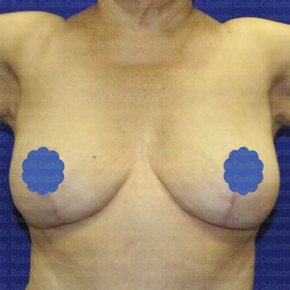 Breast Lift Patient with Breast Lift Without Implants - After