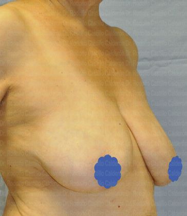 Breast Lift: Patient with Breast Lift Without Implants - Before Breast lift without implants oblique view