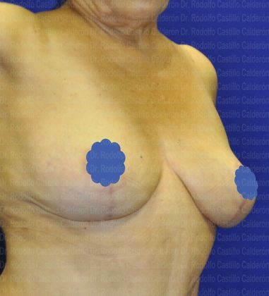 Breast Lift: Patient with Breast Lift Without Implants - After Breast lift without implants oblique view