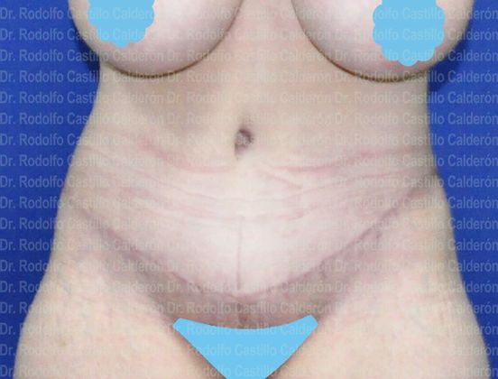 Post Bariatric Plastic Surgery 360 Tummy Tuck (Belt Lipectomy) - After