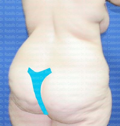 Post Bariatric Plastic Surgery: 360 Tummy Tuck (Belt Lipectomy) - Before Belt Lipectomy posterior-oblique view