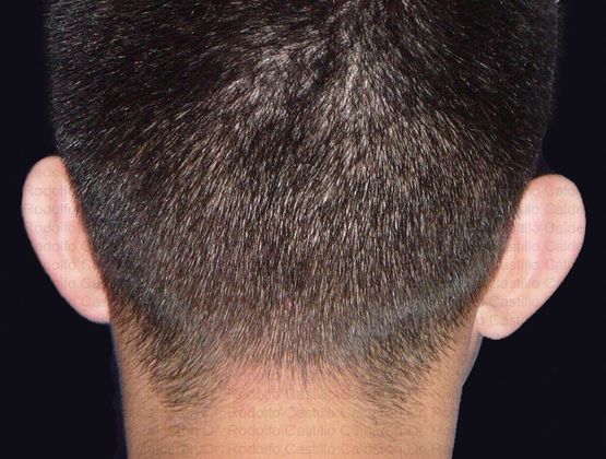 Otoplasty Male Otoplasty - Before