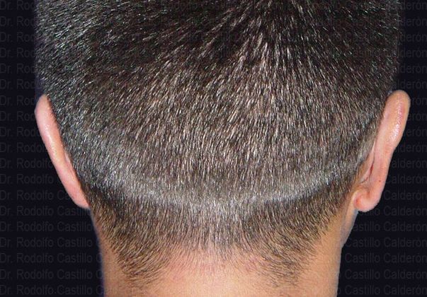 Otoplasty Male Otoplasty - After