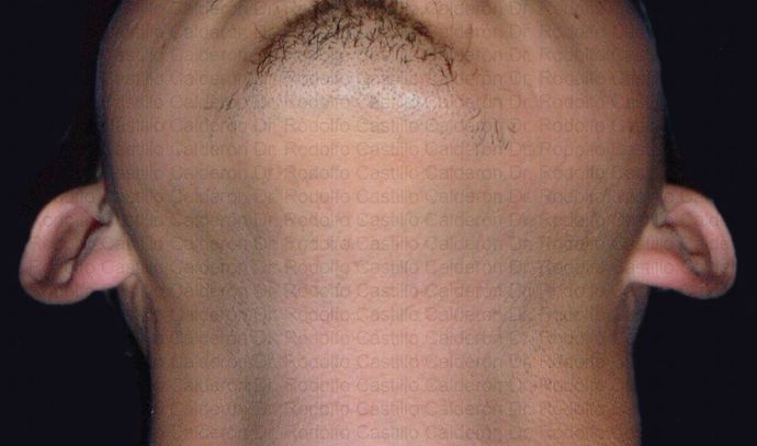 Otoplasty: Male Otoplasty - Before otoplasty inferior view