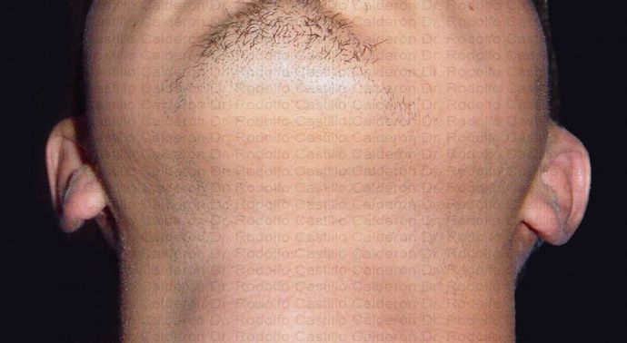 Otoplasty: Male Otoplasty - After otoplasty inferior view