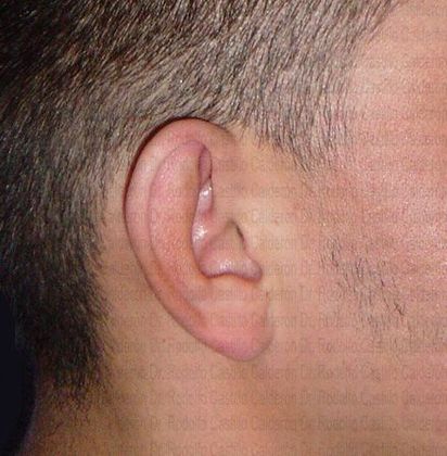Otoplasty: Male Otoplasty - Before otoplasty lateral view