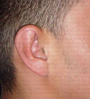 Otoplasty: Male Otoplasty - After otoplasty lateral view