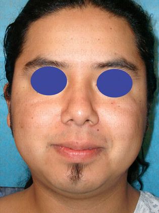 Bichatectomy (Cheek fat pad removal): Male Bichatectomy - Before cheek fat pad removal (bichat)