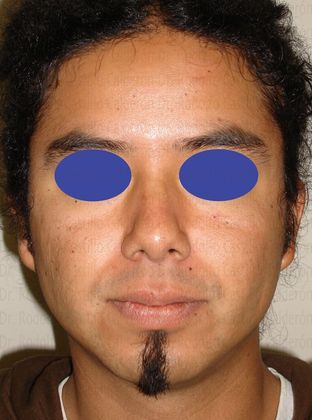 Bichatectomy (Cheek fat pad removal): Male Bichatectomy - After cheek fat pad removal