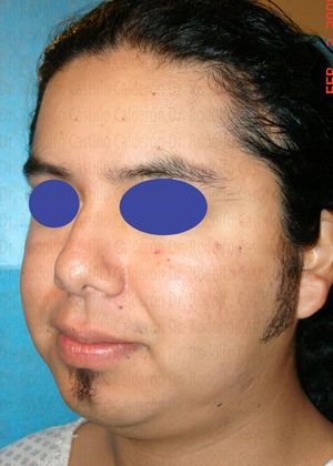 Bichatectomy (Cheek fat pad removal): Male Bichatectomy - Before cheek fat pad removal (bichat) oblique view (b