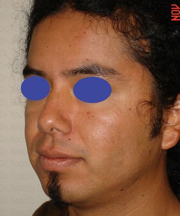 Bichatectomy (Cheek fat pad removal): Male Bichatectomy - After cheek fat pad removal oblique view