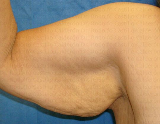 Post Bariatric Plastic Surgery Arm Lift (Braquioplasty) - Before