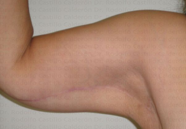 Post Bariatric Plastic Surgery Arm Lift (Braquioplasty) - After