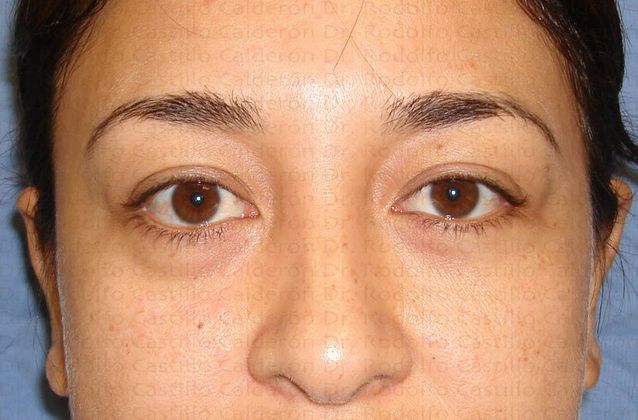 Blepharoplasty Blepharoplasty - Before