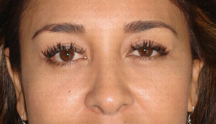 Blepharoplasty Blepharoplasty - After