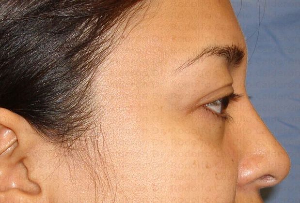 Blepharoplasty: Blepharoplasty - Before eyelid surgery lateral view