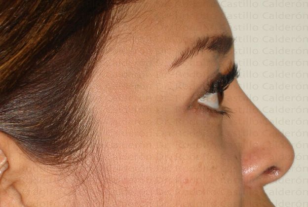 Blepharoplasty: Blepharoplasty - After eyelid surgery lateral view