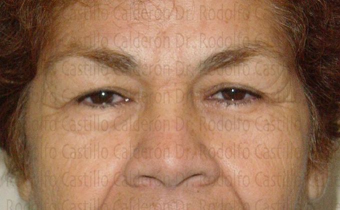 Blepharoplasty Eyelid Surgery (over 50) - Before