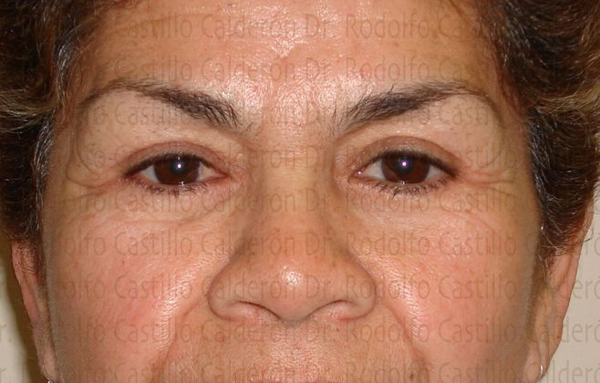 Blepharoplasty Eyelid Surgery (over 50) - After