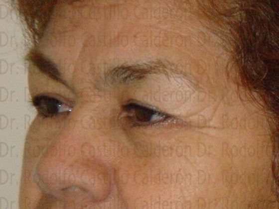 Blepharoplasty: Eyelid Surgery (over 50) - Before eyelid surgery oblique view